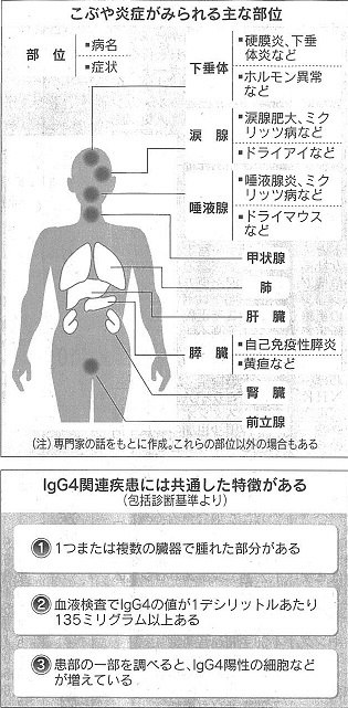 IgG4関連疾患とは | 吉村やすのり 生命の環境研究所